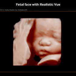 Cara fetal con FRV TM