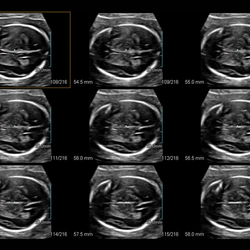 Cerebro fetal en Multi Slice ViewTM