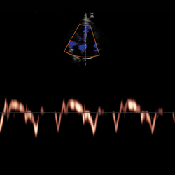 Corazón adulto con PulseWave TDI