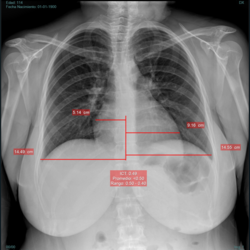 Índice cardiotorácico