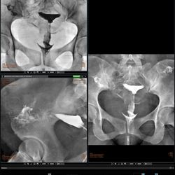 Histerosalpingografía