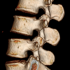 lateral