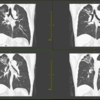 pulmones