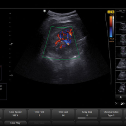 Abdomen con Doppler