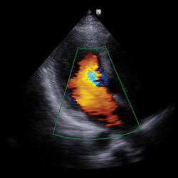 Corazón de adulto con Doppler Color