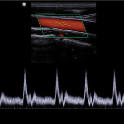 CCA con Doppler Color y espectral