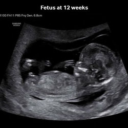 Feto 12 semanas